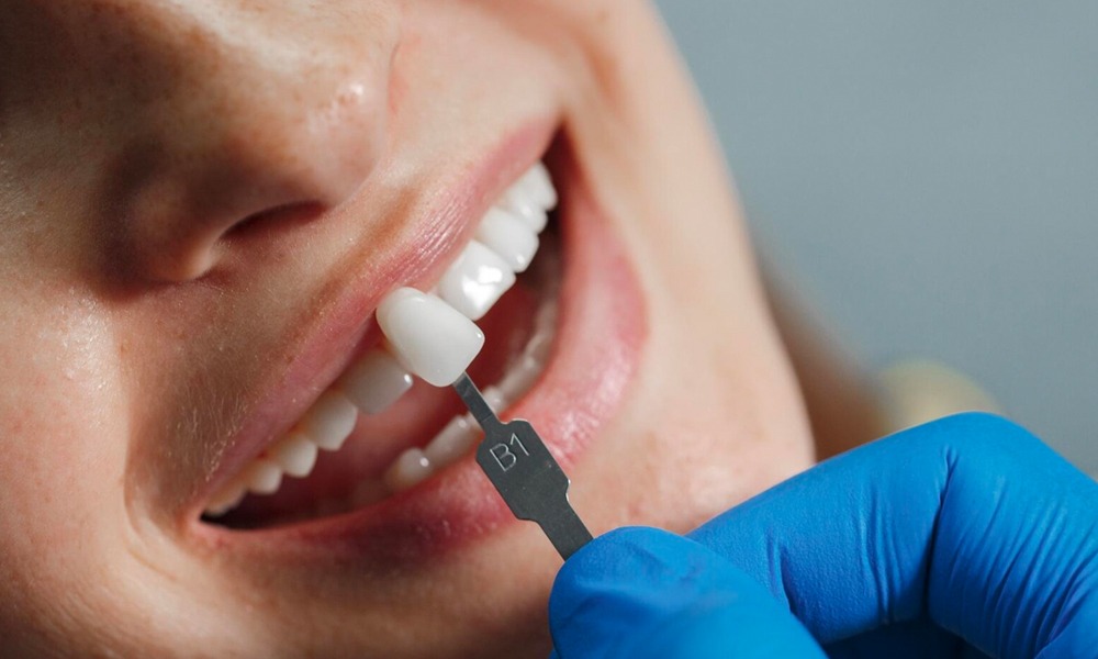 Tenemos precio especial en las carillas dentales que pueden cambiar su sonrisa de manera increible.