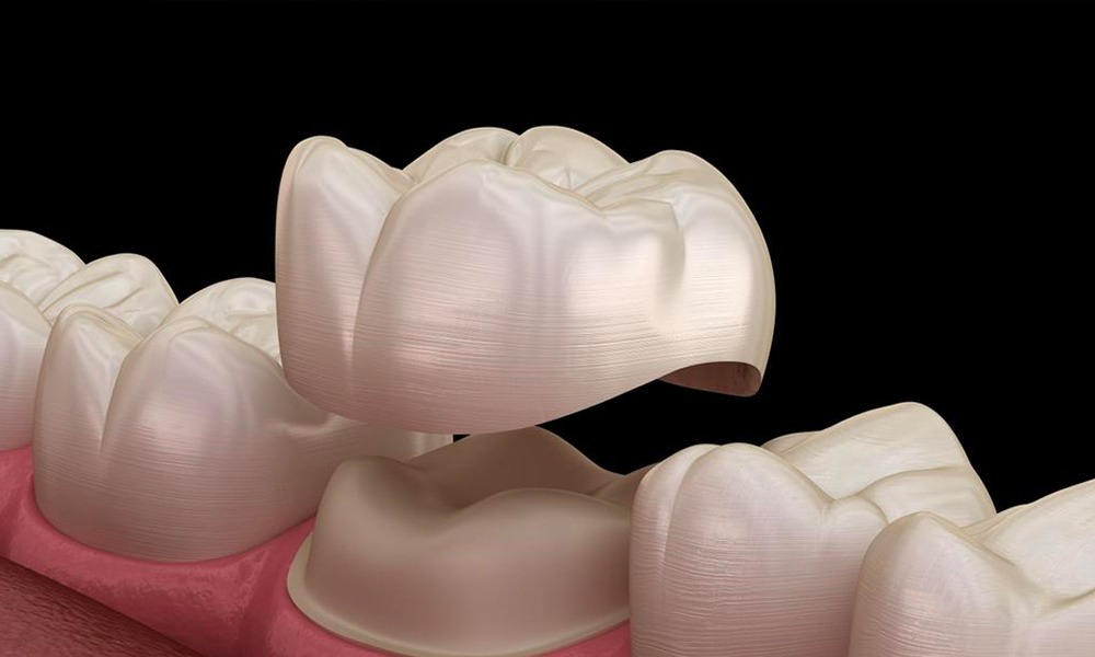 Servicio detallado y precio especial en coronas dentales.