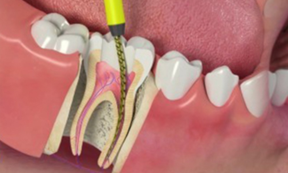 Aliviamos su dolor con un tratamiento de endodoncia a precio especial.