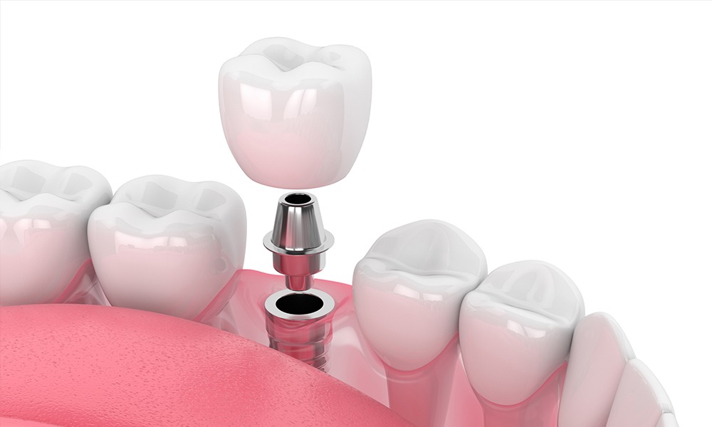 Ofrecemos precio especial en el servicio de implante dental.