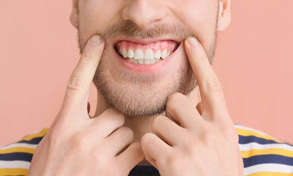 Ofrecemos un tratamiento especial para la sonrisa gingival.