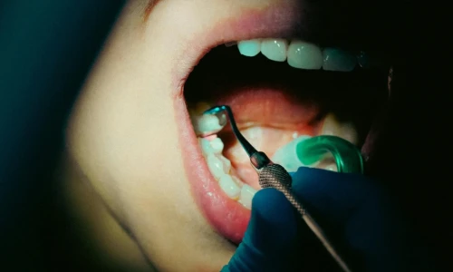 ¿Cómo prevenir las caries?