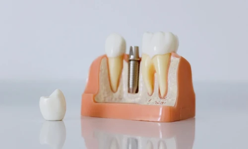 Tipos de materiales de las coronas dentales
