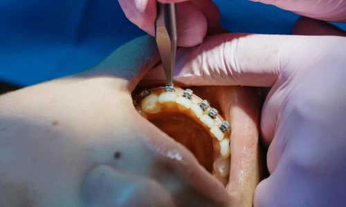 Tipos de ortodoncia y cuál es la adecuada para usted