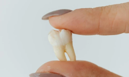 ¿Cuándo se hace una extracción dental?