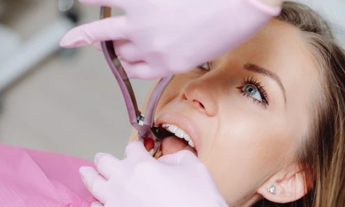 ¿Cuándo se hace una extracción dental?