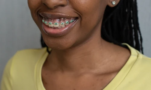 ¿Cuánto tiempo debo llevar brackets?