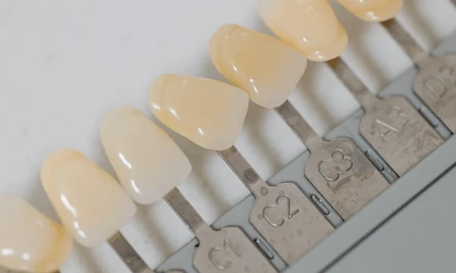 Vida útil de las carillas dentales