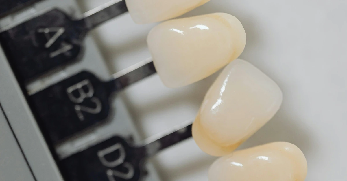 ¿Qué son las carillas dentales?