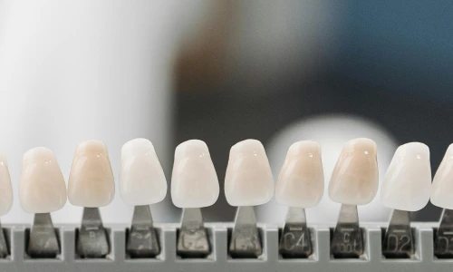 Beneficios de las carillas dentales