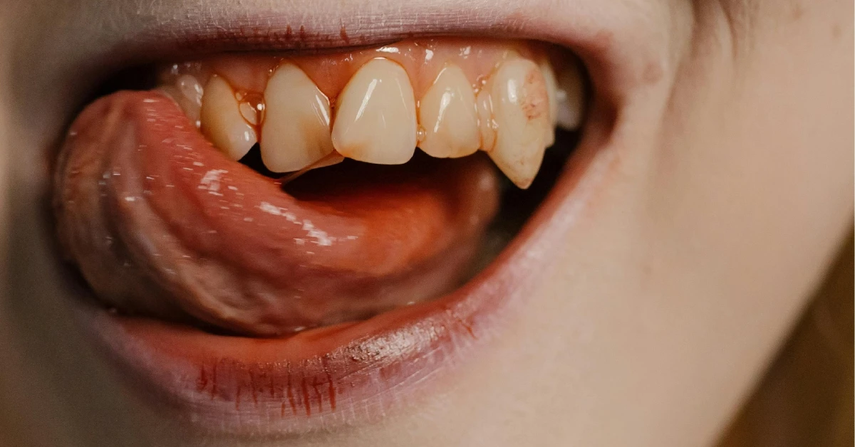 Cómo detectar las primeras señales de gingivitis