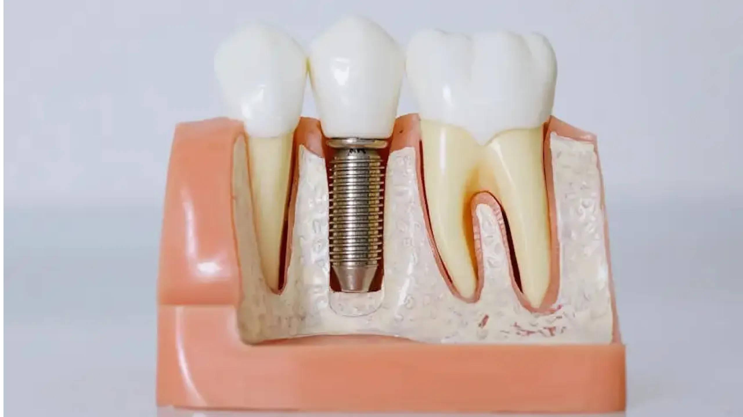 Pasos para colocarse un implante dental