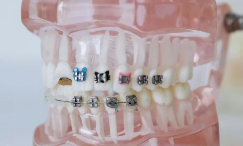 Los beneficios de usar brackets