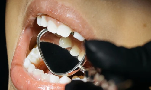 What Should I Do If I Break a Tooth?
