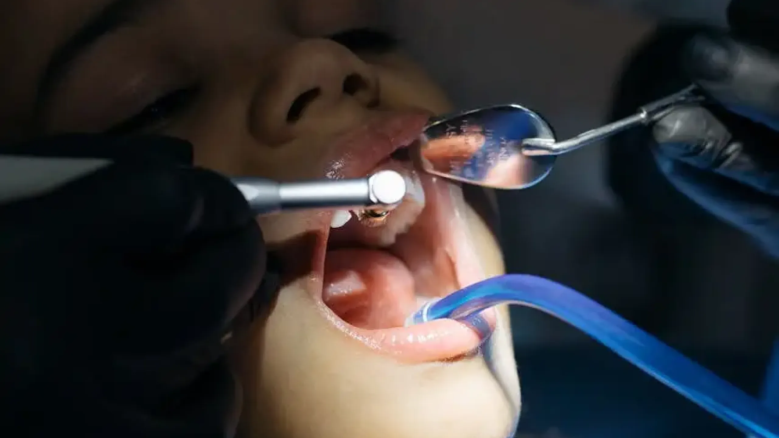 Benefits of Fluoride for Dental Health: What You Need to Know