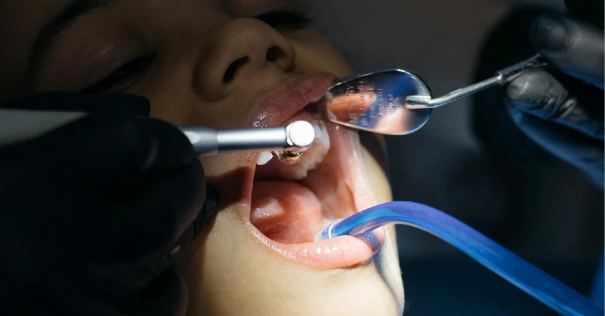 Beneficios del fluoruro en la salud dental: Lo que debes saber