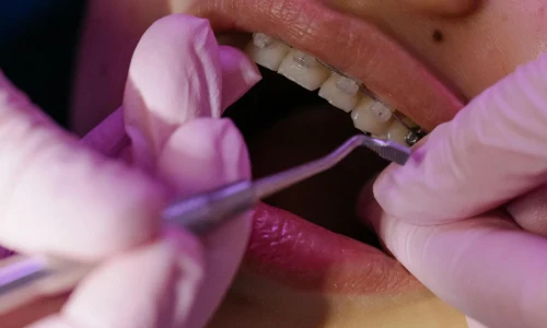 Retos de la limpieza dental con brackets
