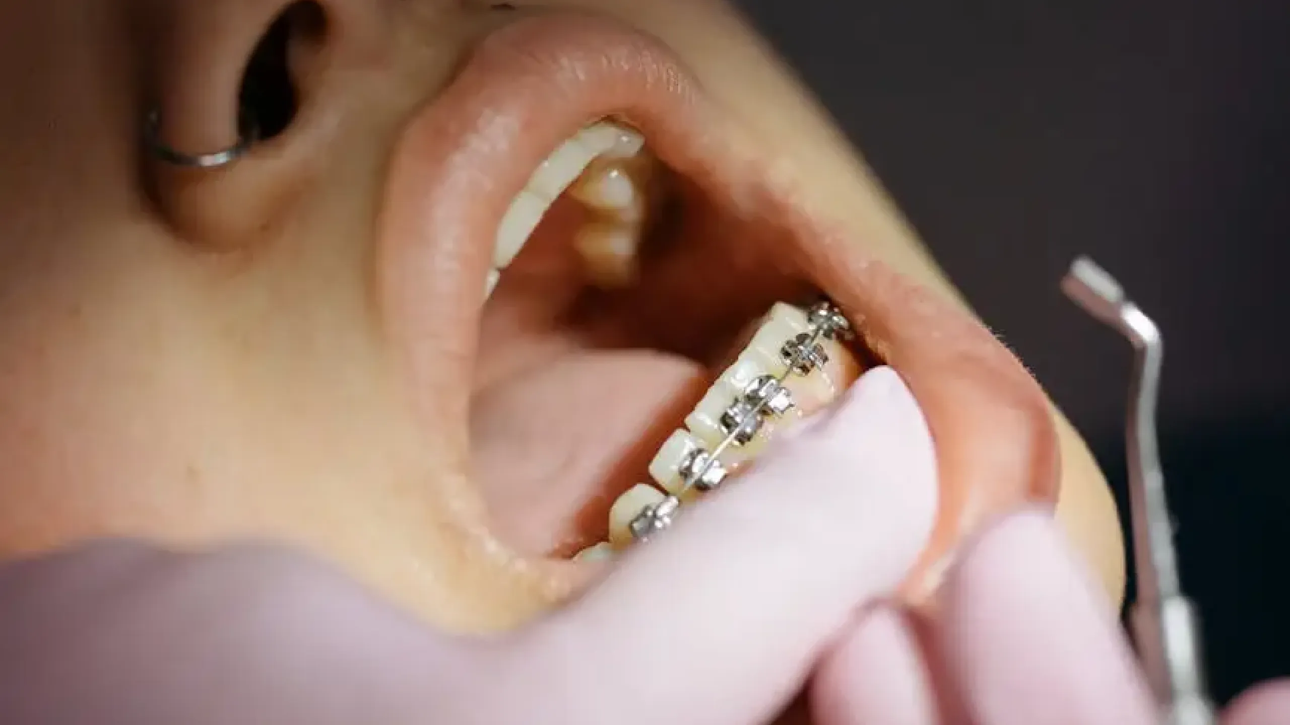 ¿A qué edad se pueden usar los brackets?