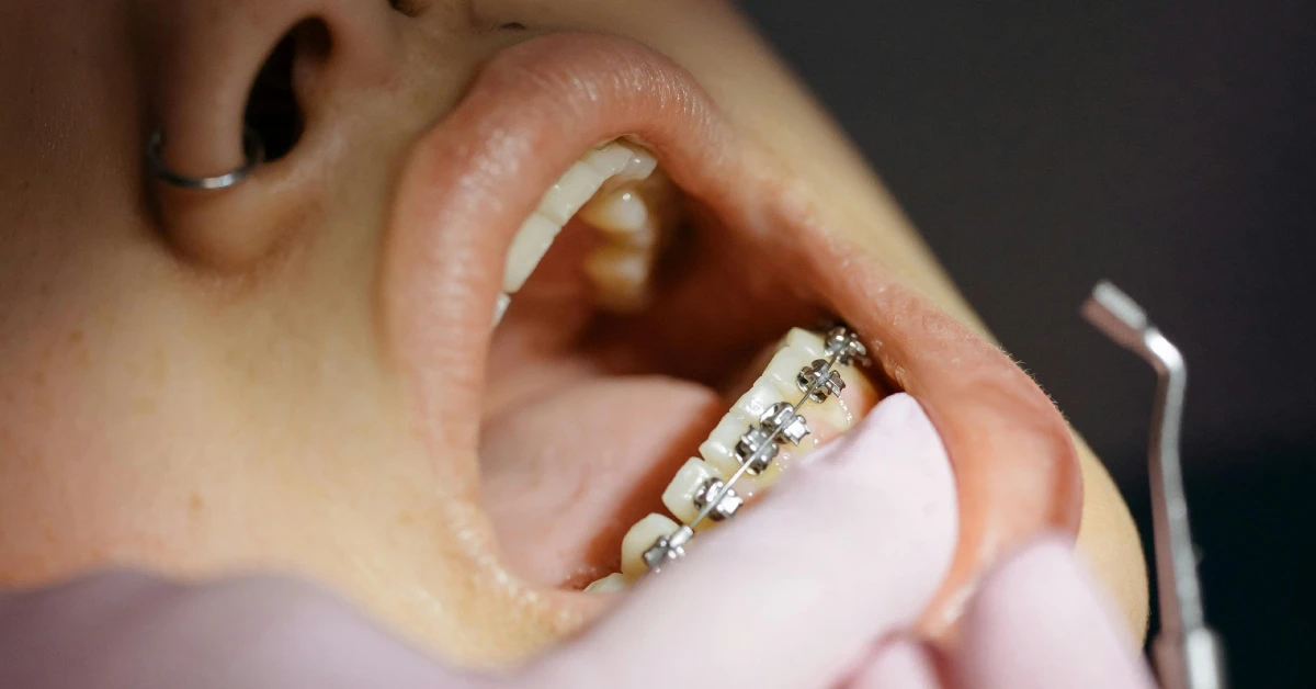 What age can use braces?