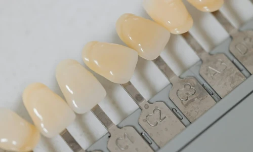 Tipos de carillas dentales