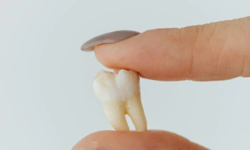¿Cuándo necesito una extracción dental?