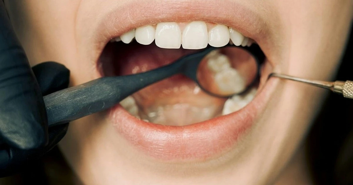 Common Problems Caused by Cavities