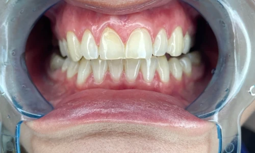 How to Avoid Gingivitis