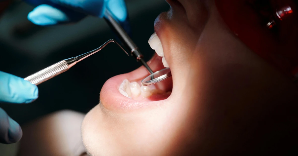 Can I Lose a Tooth from a Cavity?