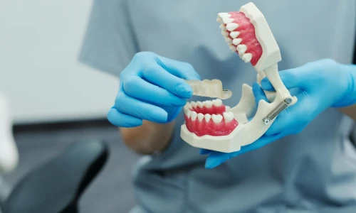 What Are Dental Bridges?