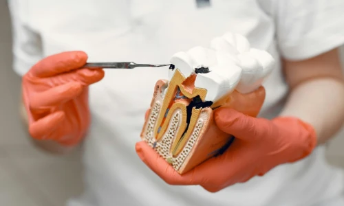 What Is a Root Canal Surgery?