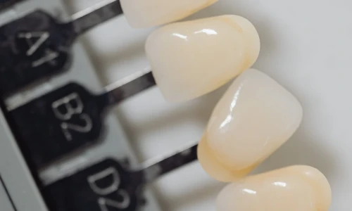 Which Teeth Cannot Have Veneers?