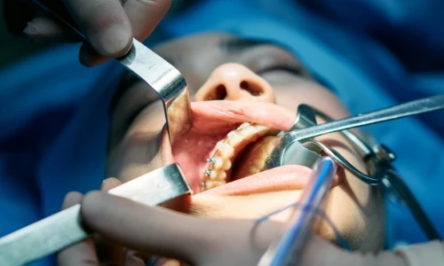Common Oral Surgeries