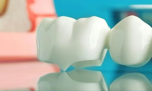 ¿Qué son los puentes dentales?