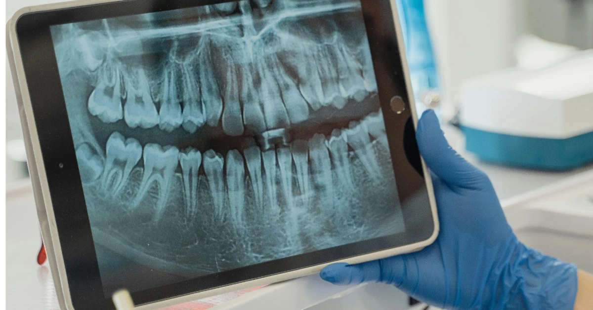 ¿Cuándo usar rayos X en odontología?