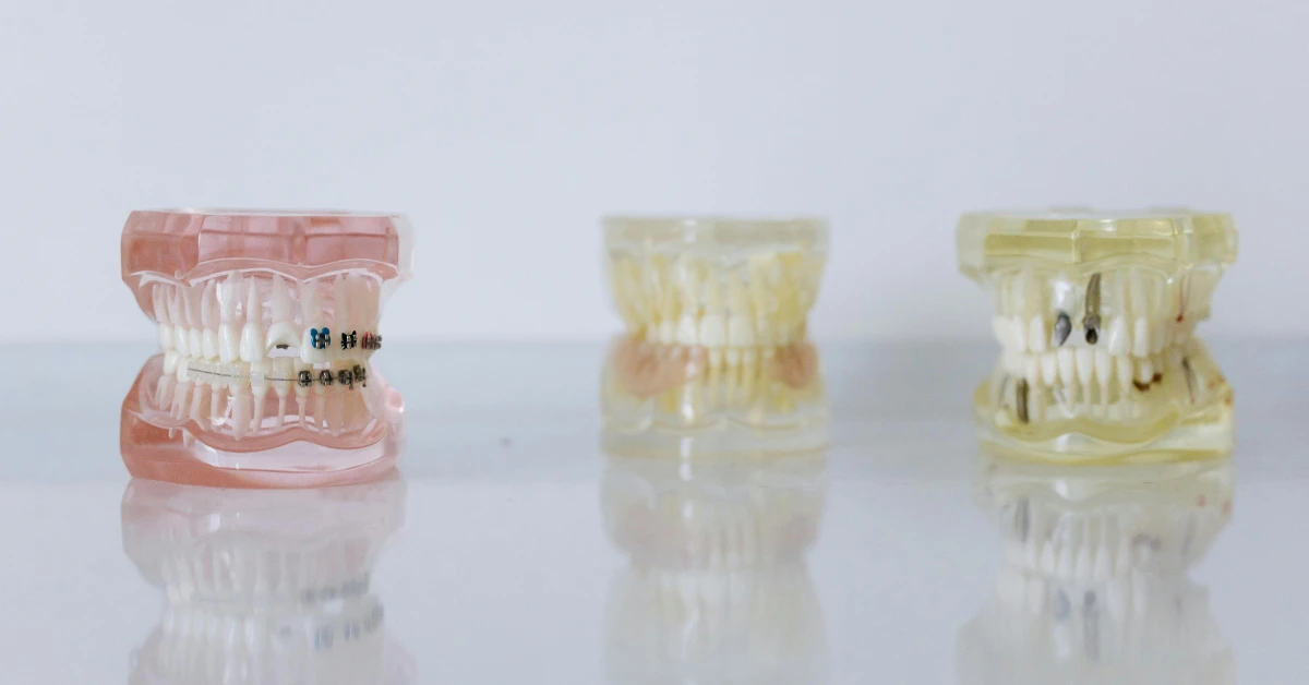 Tipos de prótesis dentales