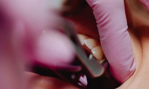 Enfermedades de encías