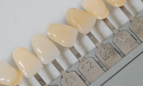 ¿Qué son las carillas dentales?