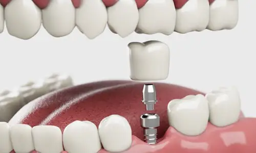 100 dollars off dental implants.