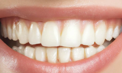 How to Keep a Perfect Smile