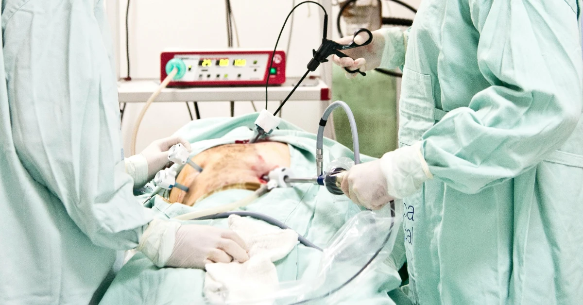 ¿Qué es la manga gástrica por endoscopia?