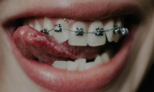 Problems of Crooked Teeth