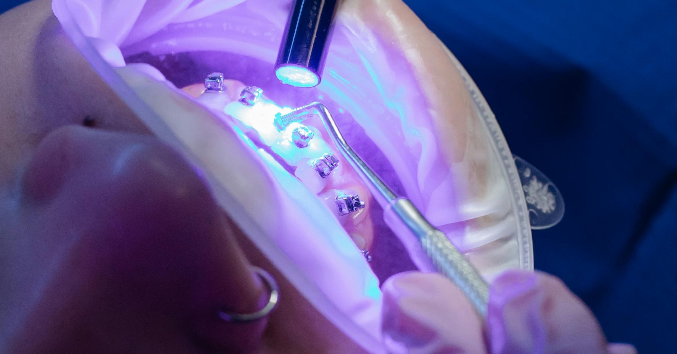 When Should I Use Orthodontics to Improve My Smile?