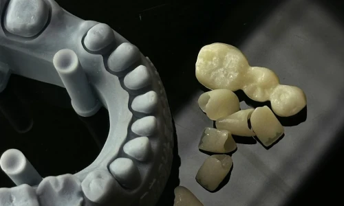 Tipos de implantes dentales