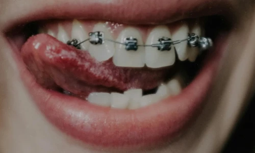 When Do I Need Braces?