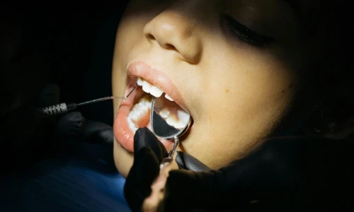 Problemas de las caries