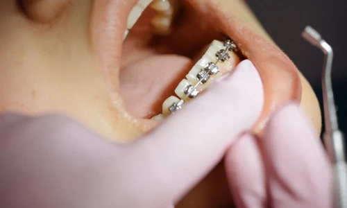 ¿Cuánto tiempo debo usar brackets?