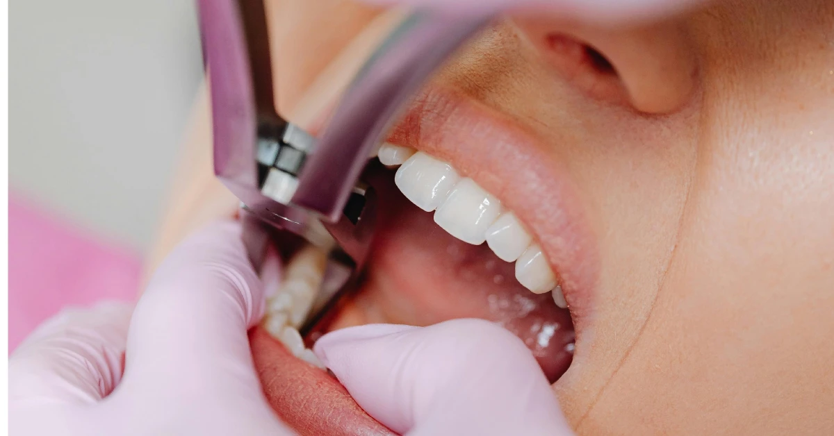 When to Extract a Wisdom Tooth