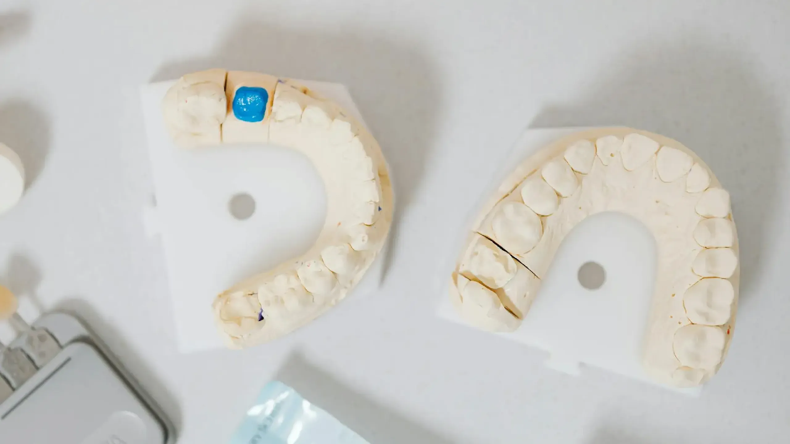Implantes dentales vs puentes dentales