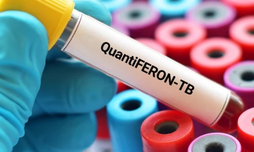 ¿Qué son las pruebas QuantiFERON-TB Gold?