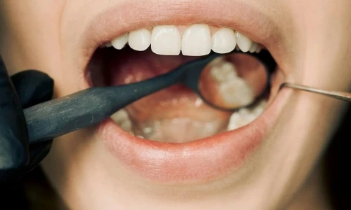 Problemas de las caries